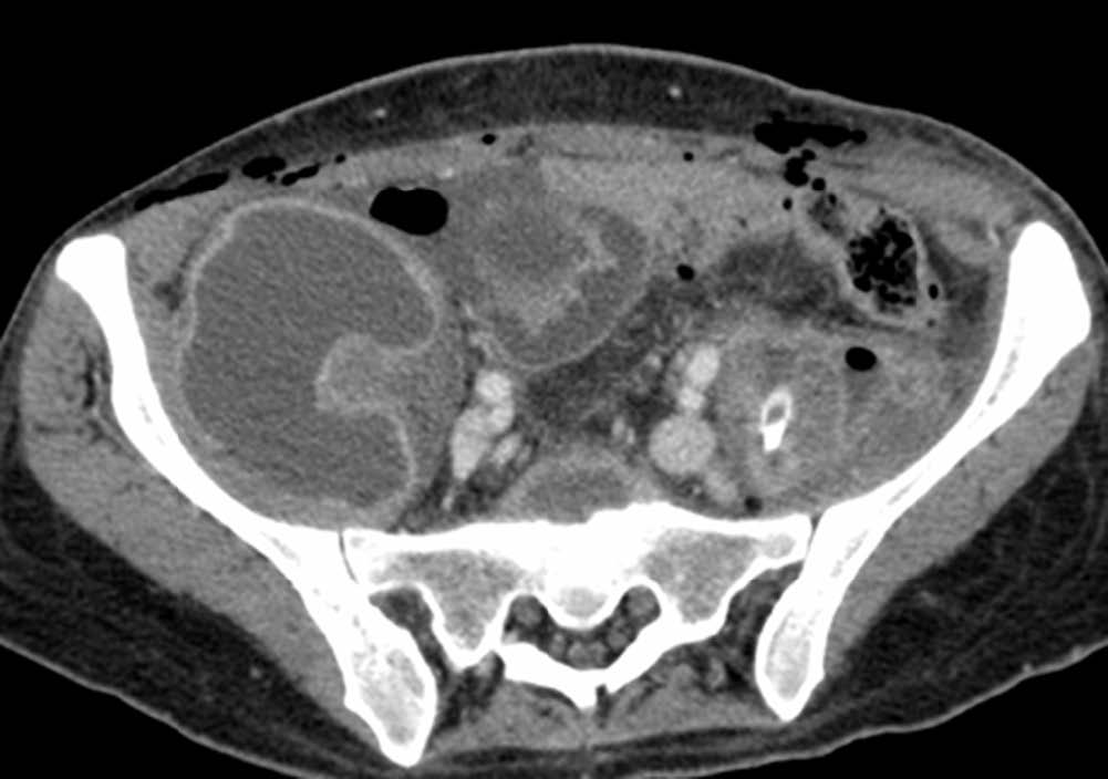 Tratamiento del absceso retroperitoneal