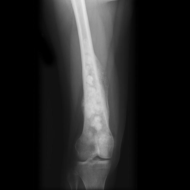 El osteosarcoma afecta principalmente huesos largos