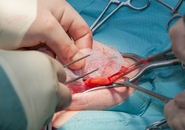 La reparación de hernias es una intervención muy común
