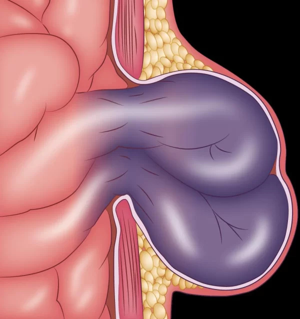 ¿Qué es una hernia estrangulada?