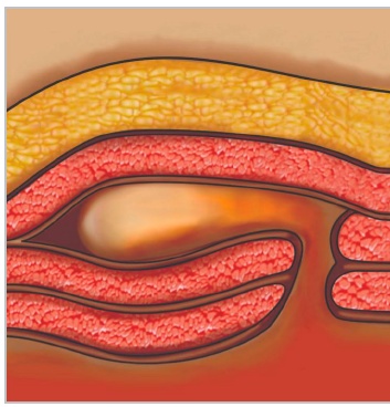 ¿Qué es una hernia interparietal?